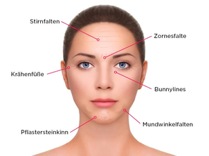 Welche Falten kann man mit Botox unterspritzen?