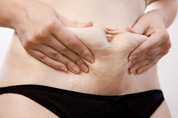 Patienten mit Ansammlung von Fett oder überschüssiger Haut im Bauchraum sind geeignete Kandidaten
