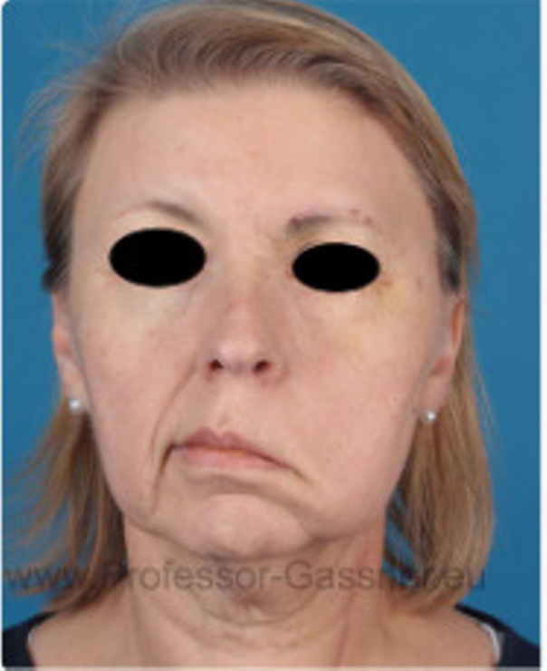 Patientin erlitt eine komplette Gesichtsnervenlähmung.