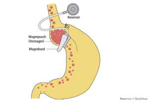 Der Magen wird mithilfe des Bandes verkleinert - AWMF