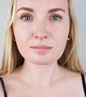 Nach der Entfernung des Doppelkinns