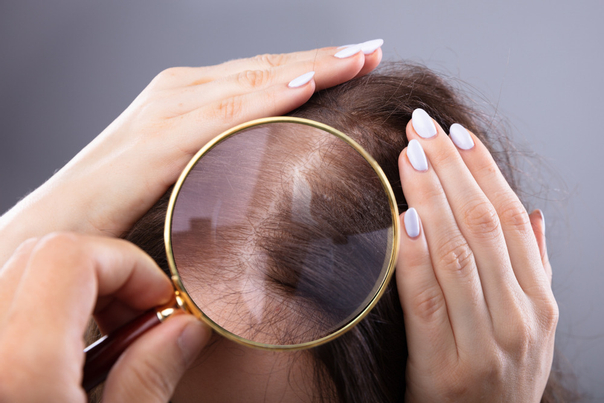 Auch Frauen können aus den verschiedensten Gründen von Haarausfall betroffen sein