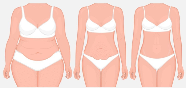 Die Abdominoplastik ist eine der am häufigsten durchgeführten Operationen weltweit