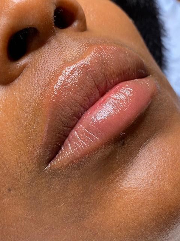 Lippen aufspritzen mit Filler schafft Volumen und Konturierung