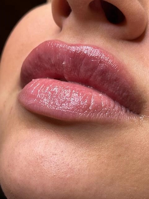 Behandlung der Ober- und Unterlippe