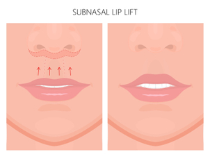 Der Abstand zwischen Nase und Oberlippe wird verkürzt