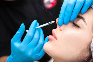 Minimalinvasiven Nasenkorrektur mit Fäden