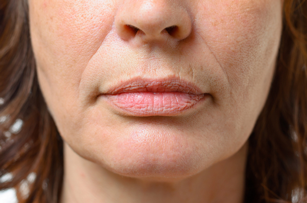 Nasolabialfalten verlaufen von der Nase zu den Mundwinkeln