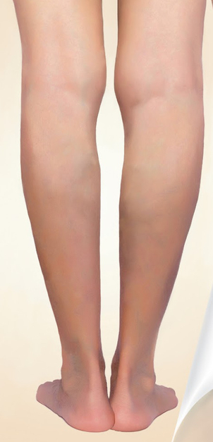 Laser Krampfaderbehandlung