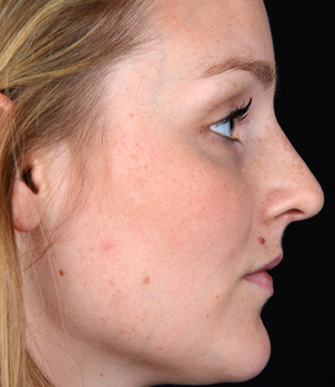 Begradigung der Nase - Dr. med. Thomas Fasching