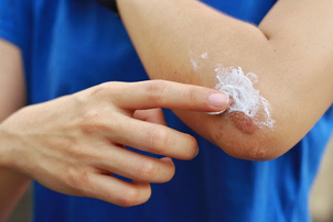 Für wen ist eine Narbenbehandlung geeignet?