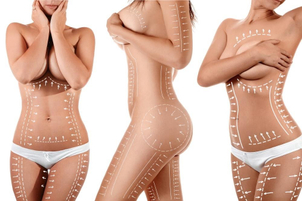 Fettabsaugung ist an nahezu allen Körperteilen möglich