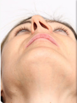 Alternativen zur Nasenscheidewandoperation