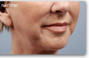 Mit wie vielen Sitzungen muss man rechnen bis das Endresultat sichtbar ist?