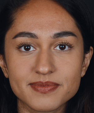 Korrektur einer Schiefnase - Dr. med. Thomas Fasching