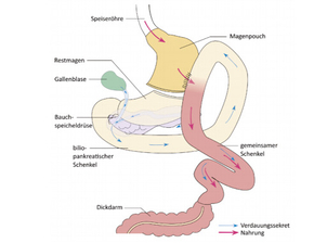 Mini-Bypass - AWMF (Arbeitsgemeinschaft der Wissenschaftlichen Medizinischen Fachgesellschaften)