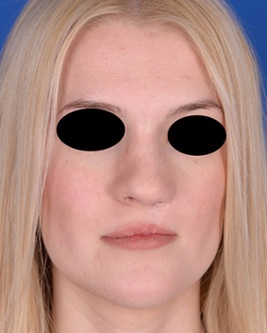 Patientin nach Lippen – Kiefer – Gaumenspalte - Prof. Dr. med. Holger Gassner