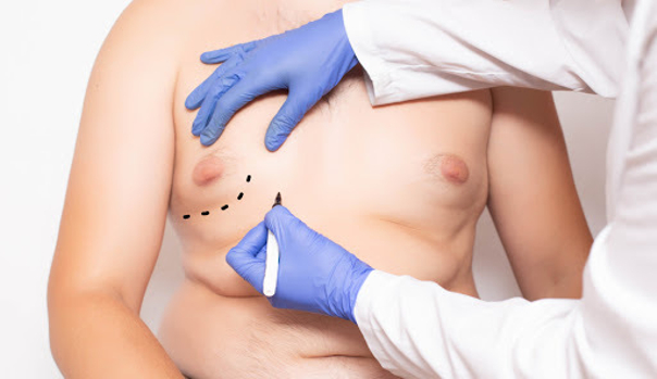 Männerbrust Ultraschall-Fettabsaugung