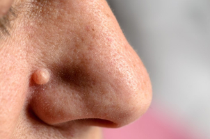 Besonders im Gesicht werden Warzen als sehr störend empfunden