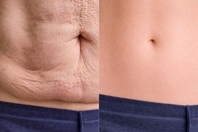 Bauchdeckenstraffung: Resultate