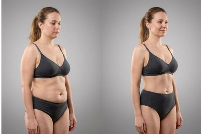 Bodylift