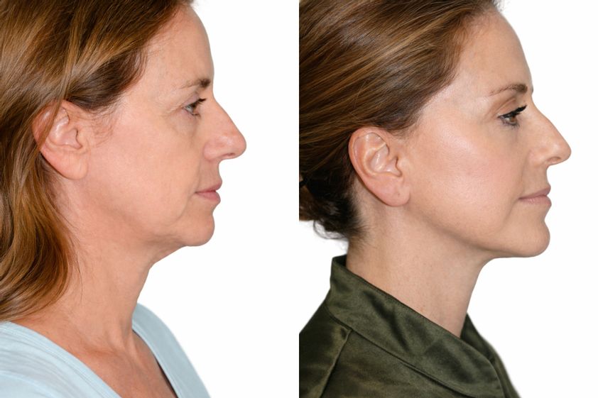 Facelift