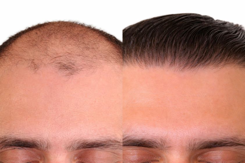 Haartransplantation