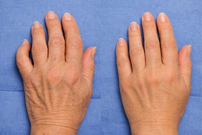 Handchirurgie: Resultate