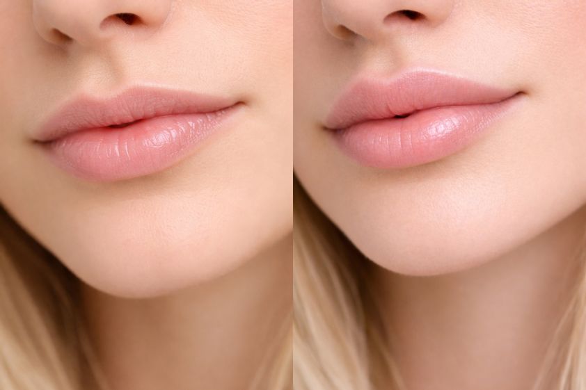 Lippenlifting
