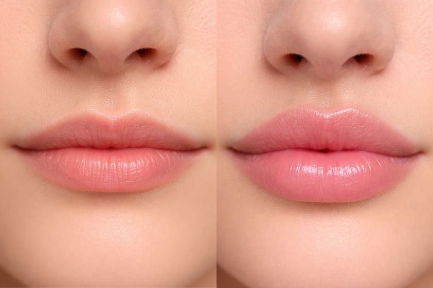 Lippenkorrektur