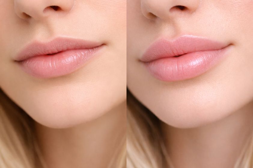 Lippen aufspritzen