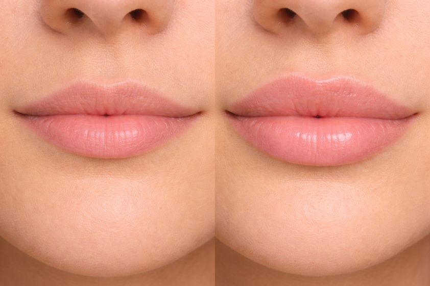Lippenvergrößerung mit Hyaluronsäure