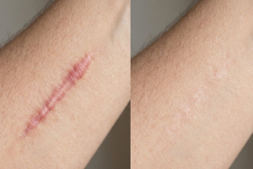 Narbenbeseitigung mit Laser