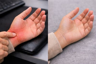 Karpaltunnelsyndrom: Resultate