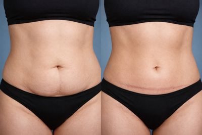 Miniabdominoplastik: Resultate
