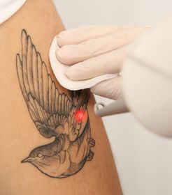 Tattooentfernung