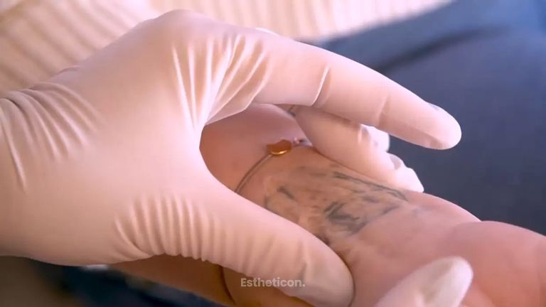 Wie können störende Tattoos mittels Laser entfernt werden?