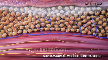 Muskelaufbau in 4 Sitzungen: das schafft nur Emsculpt!