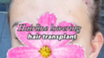 Haartransplantation - Dr. V. Caglan & Coll.