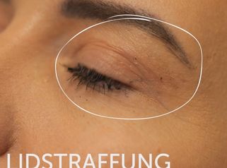 Lidstraffung von Dr. Akbas