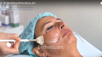 Wie läuft die Needling-Behandlung ab?