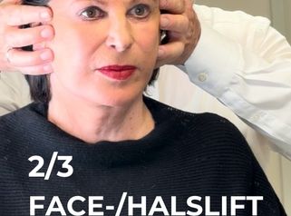 Face-Halslift was kann erreicht werden - THERESIUM │ DR. KLOEPPEL