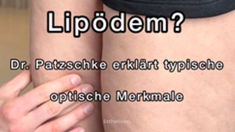 Lipödem Merkmale - THERESIUM │ DR. KLOEPPEL – Zentrum für Ästhetische Chirurgie & Medizin