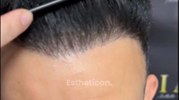 Haartransplantation