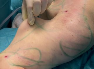 Vaser/Ultraschall Absaugung Oberarme