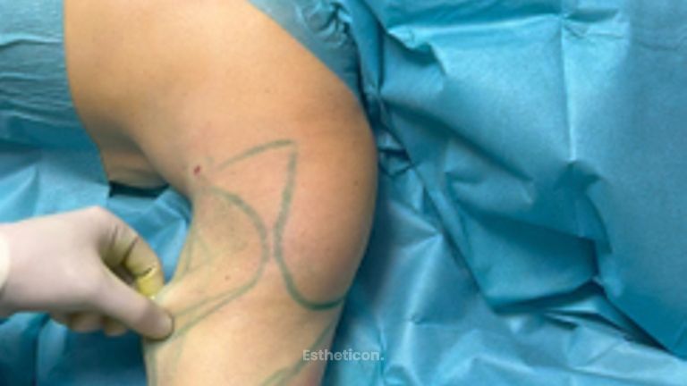 Hautstraffung Renuvion® Oberarm