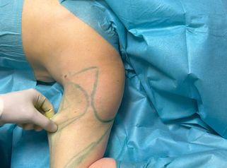 Hautstraffung Renuvion® Oberarm