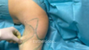 Hautstraffung Renuvion® Oberarm