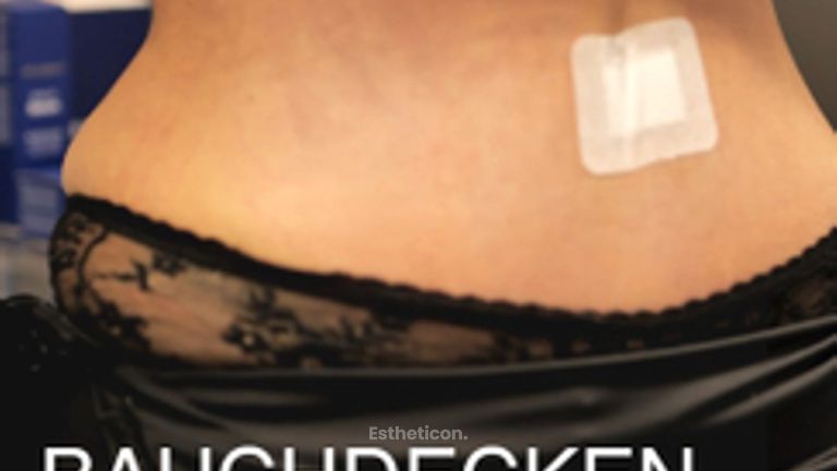 Bauchdeckenstraffung von Dr. Siebeck