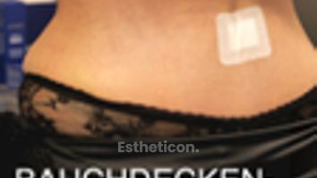 Bauchdeckenstraffung von Dr. Siebeck
